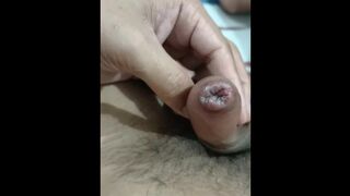 Syphilis (sexual transmitted disease) made my dick looking swallen. look at it